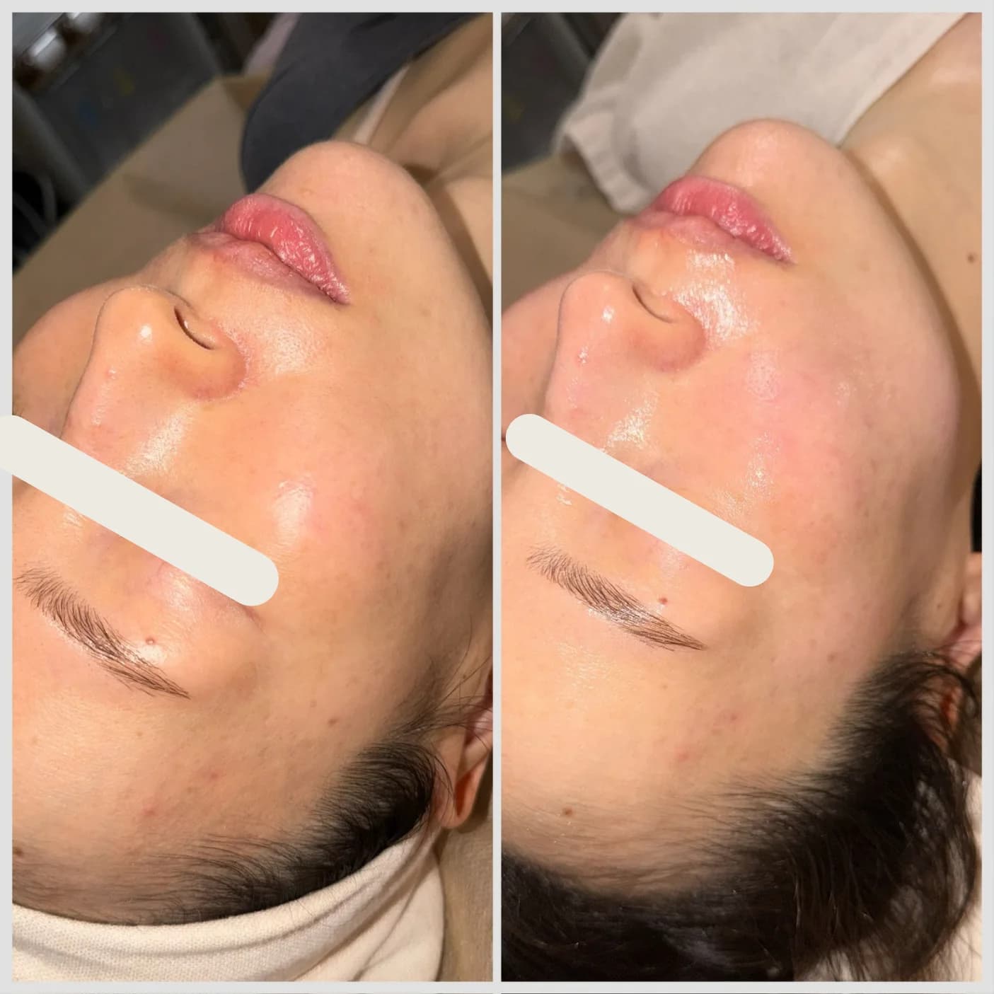 IPLフェイスリフト施術のビフォーアフター、1回、肌トーンとキメ感の改善