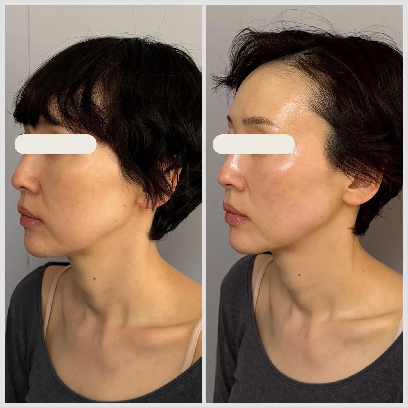 IPLフェイスリフト施術のビフォーアフター、1回、赤みと透明感の改善