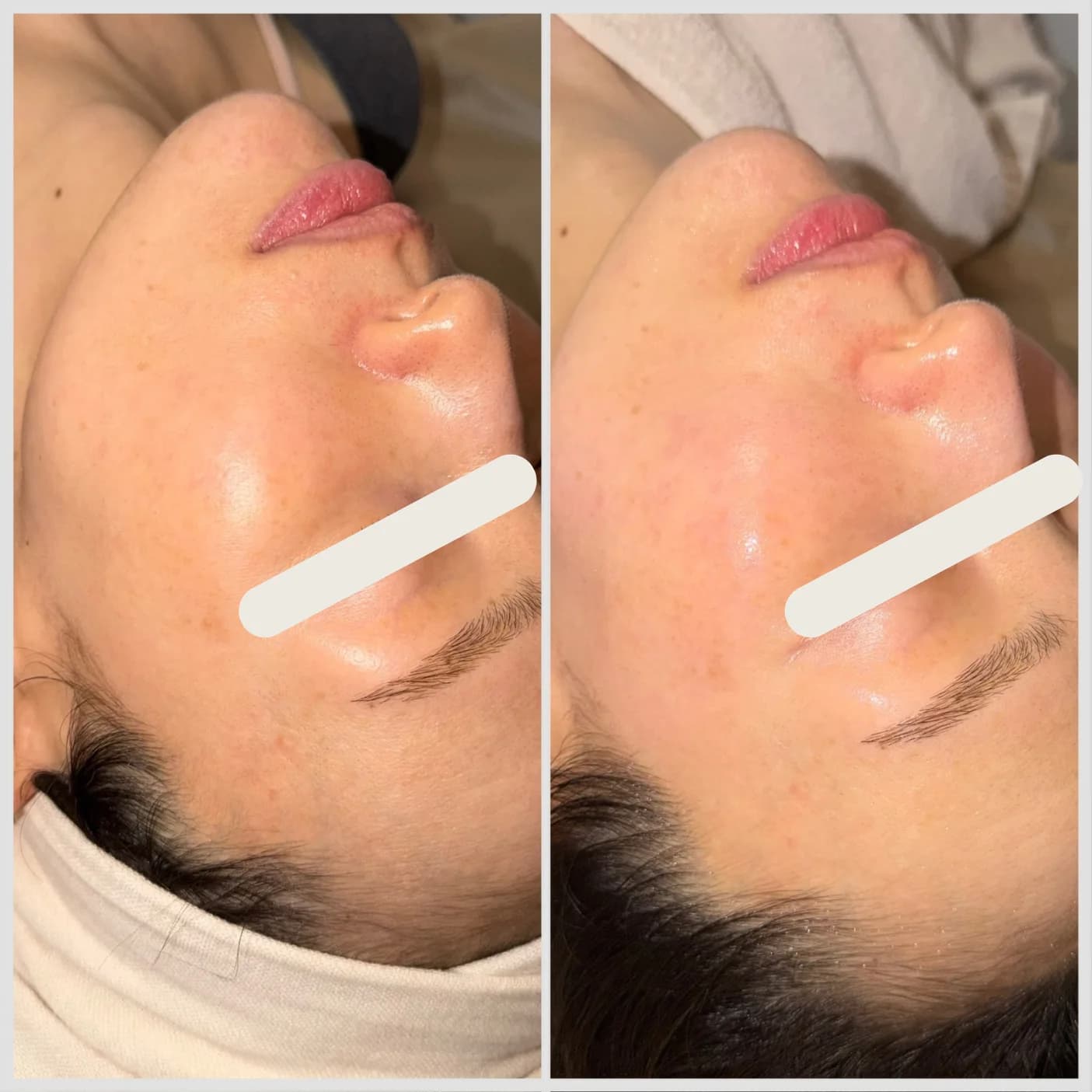 IPLフェイスリフト施術のビフォーアフター、1回、フェイスリフトとツヤ感の改善