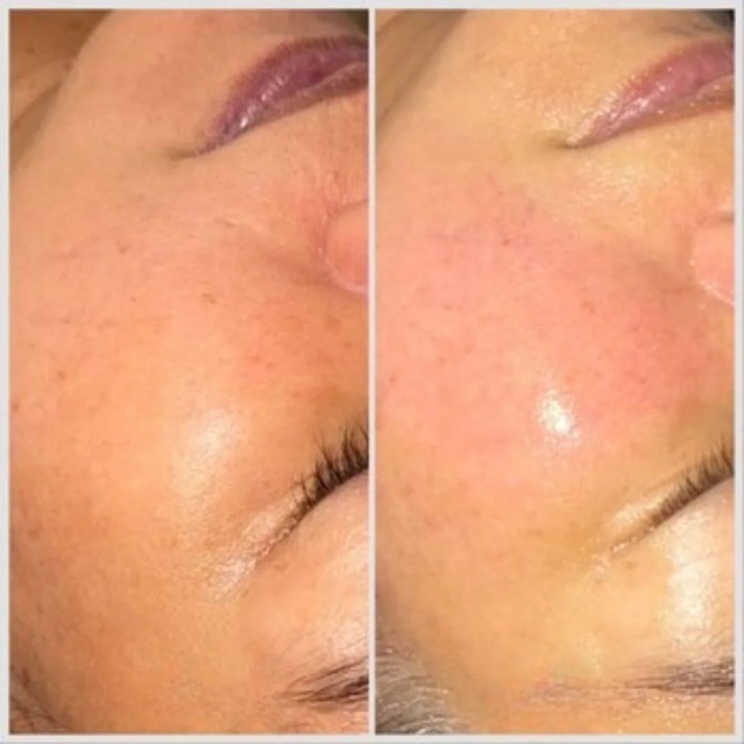 IPL施術のビフォーアフター、1回、頬の赤みと透明感の改善